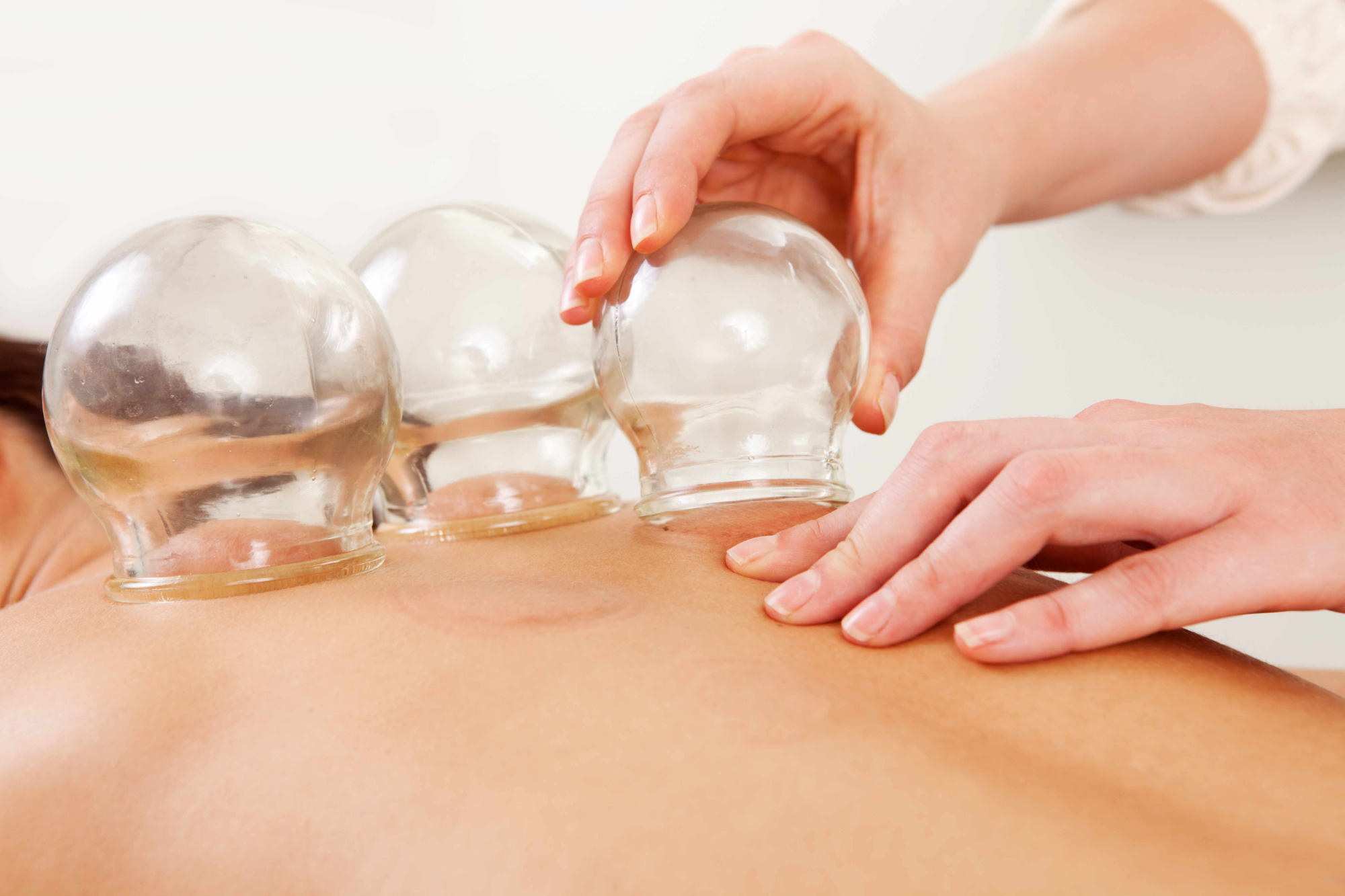 Cupping Thérapie (Hijama)